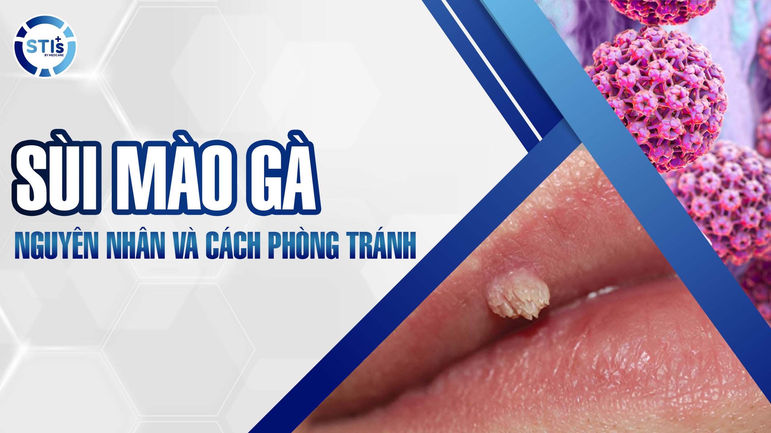 sui-mao-ga-nguyen-nhan-va-cach-phong-tranh